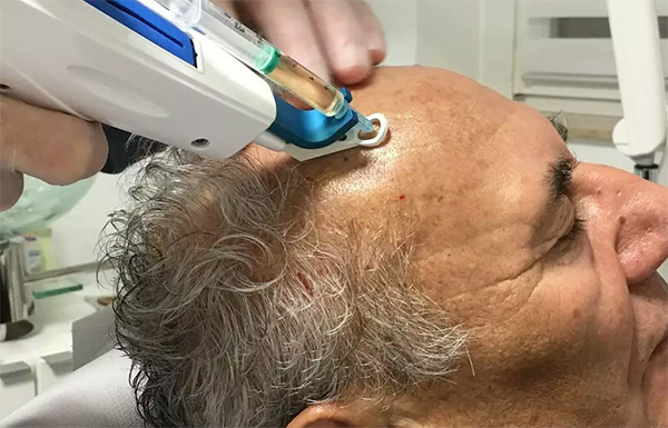 ترمیم و بازسازی مو بدون درد و جراحی