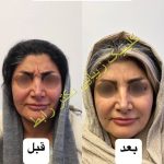 نمونه کار بوتاکس| کلینیک زیبایی فرشته