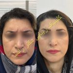 نمونه کار بوتاکس| کلینیک زیبایی فرشته