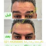 نمونه کار بوتاکس| کلینیک زیبایی فرشته
