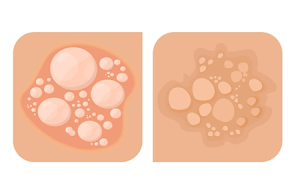 بررسی بهترین راه های درمان زگیل تناسلی