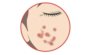 میکرودرم ابریژن یا prp کدام درمان برای جوش مناسب تر است