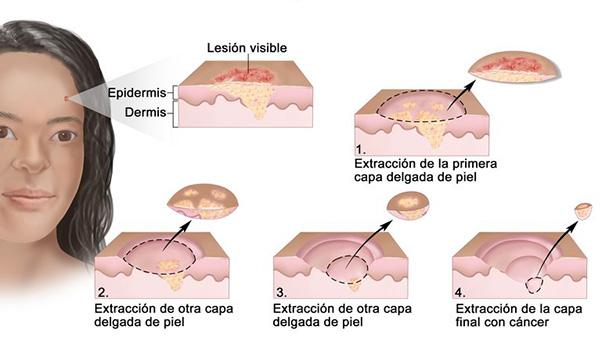 آشنایی با انواع خال های سرطانی