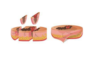 خال های سرطانی چه علائمی دارند