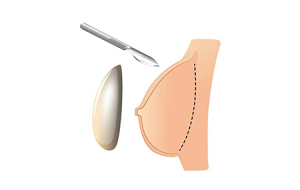 بررسی عوارض خطرناک پروتز سینه