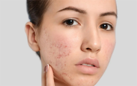 کمبود کدام ویتامین ها باعث ایجاد لک صورت میشود